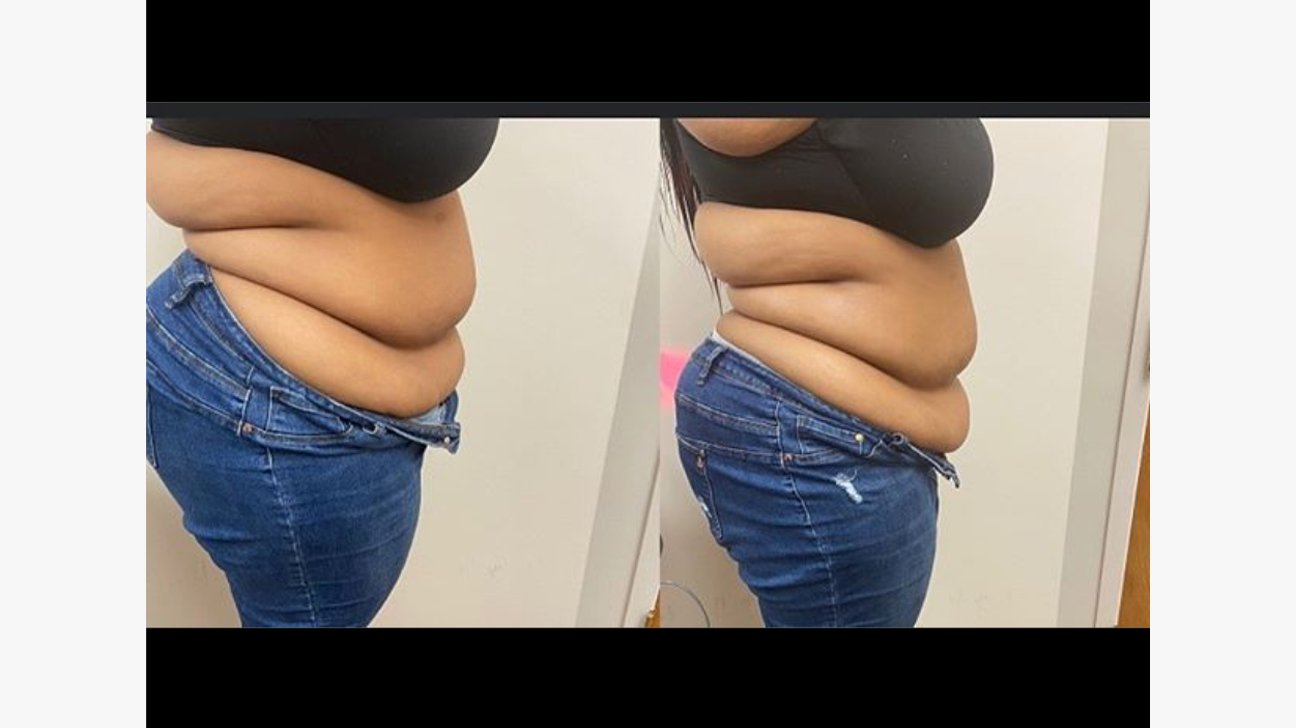 What is Lipo cavitation side effects?