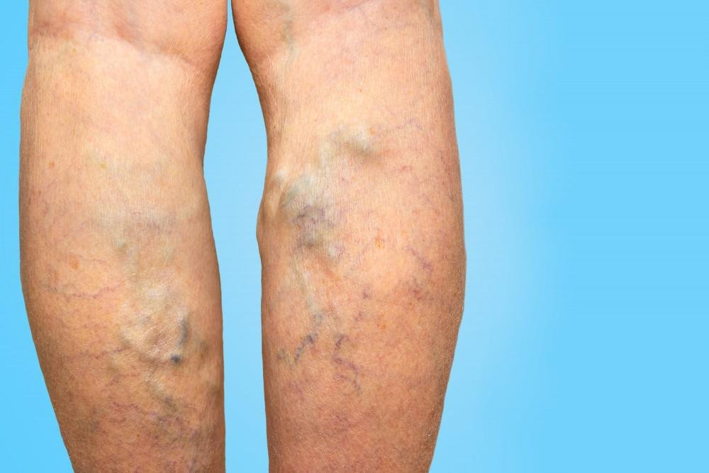 What to know about postpartum varicose veins?